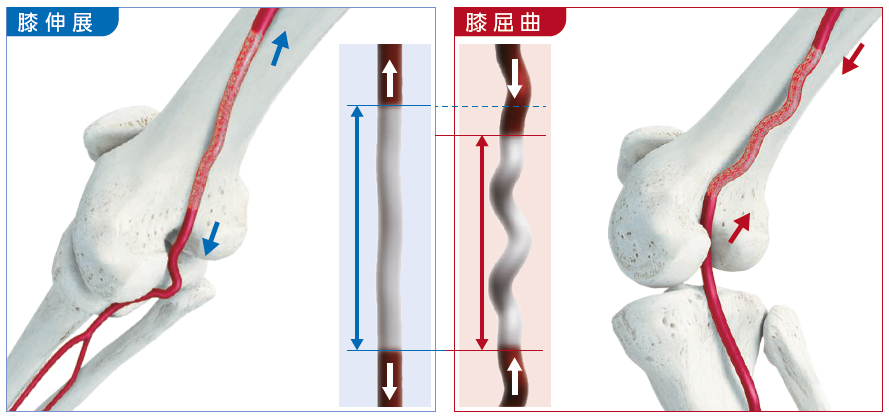 血管用ステント