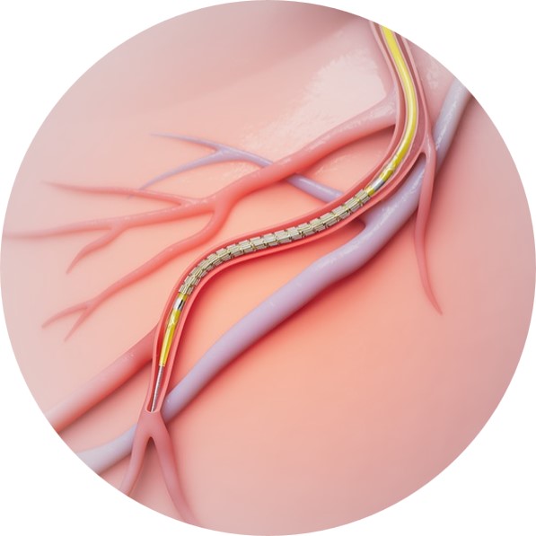 Drug-eluting stent for coronary artery disease